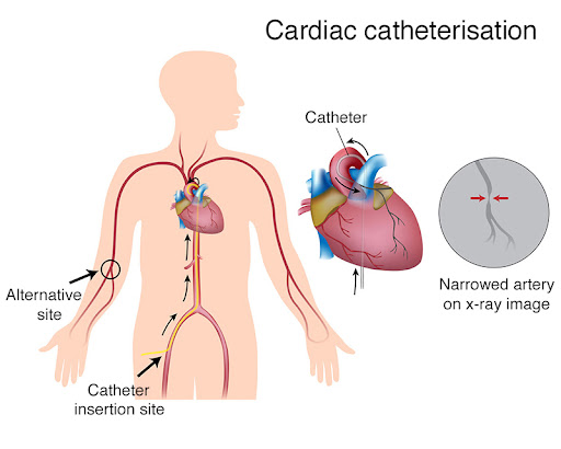 کاتتریسم قلبی در اصفهان
